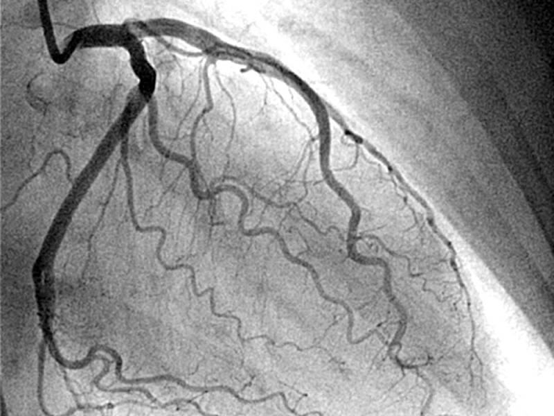 Coronary Angiography and Angioplasty in pune