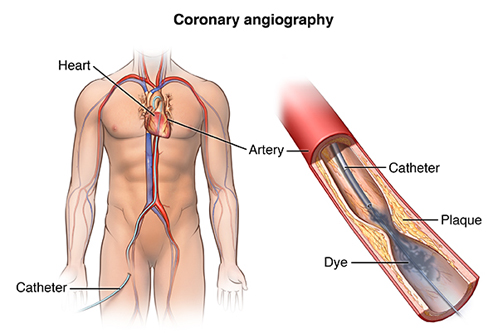 Angiography in Pimpri Chinchwad